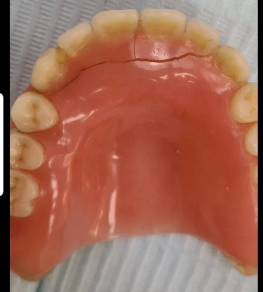 cracked denture
