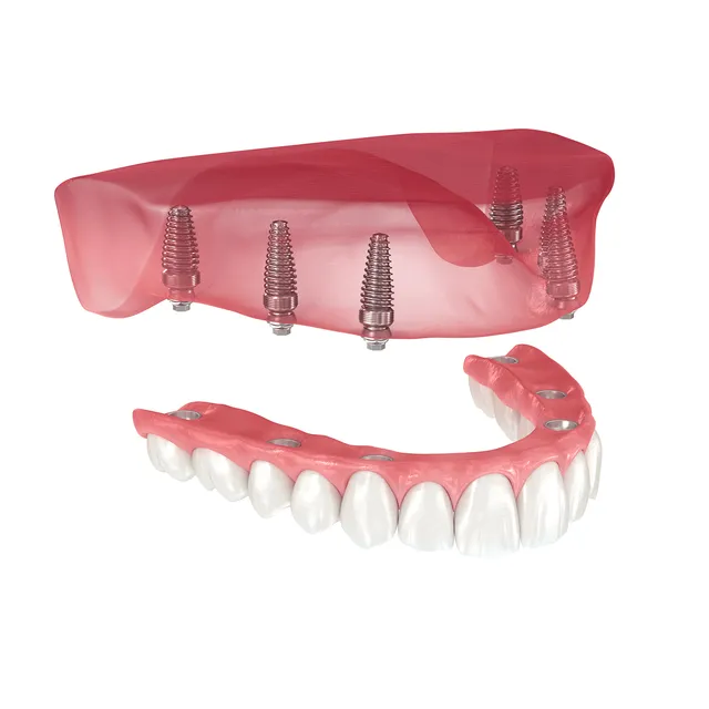 over denture